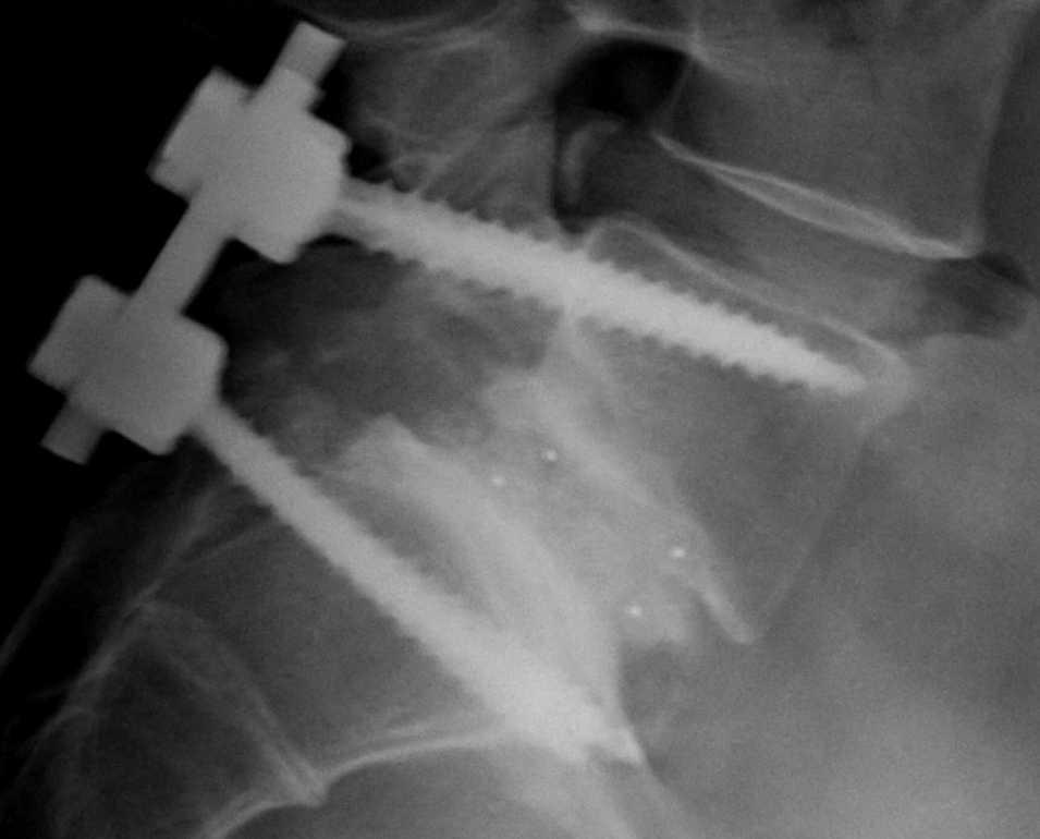 tlif-surgery-2 TLIF Surgery (Transforaminal Lumbar Interbody Fusion)