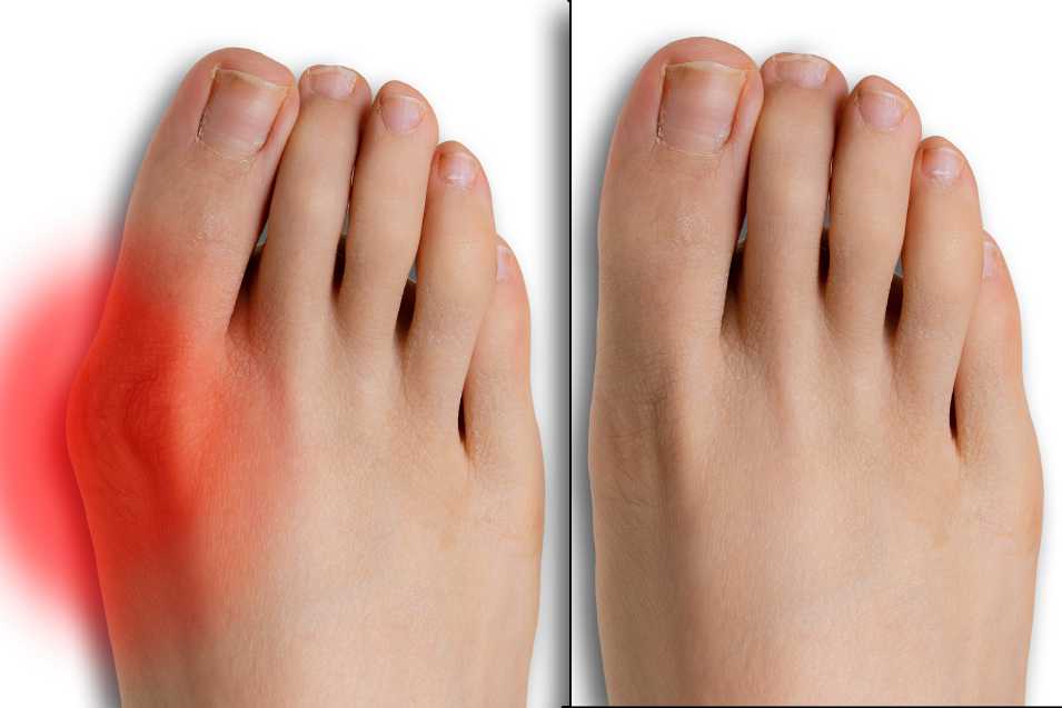 What to Expect After Bunion Surgery?