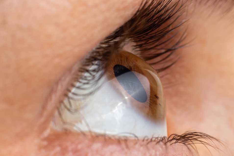 Corneal Refractive Therapy