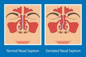 Cost of Deviated Septum Surgery in 2026