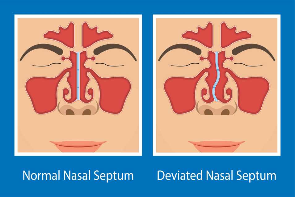 is deviated septum surgery covered by insurance, does insurance cover deviated septum surgery, how much does deviated septum surgery cost