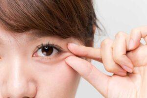 Double Eyelid Surgery