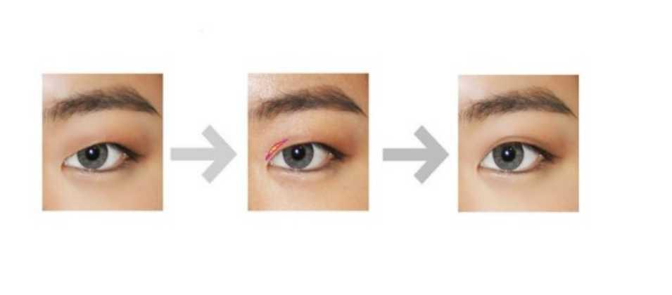 Double Eyelid Surgery