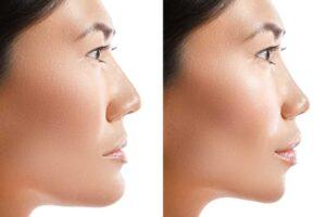 Facial Feminization Surgery