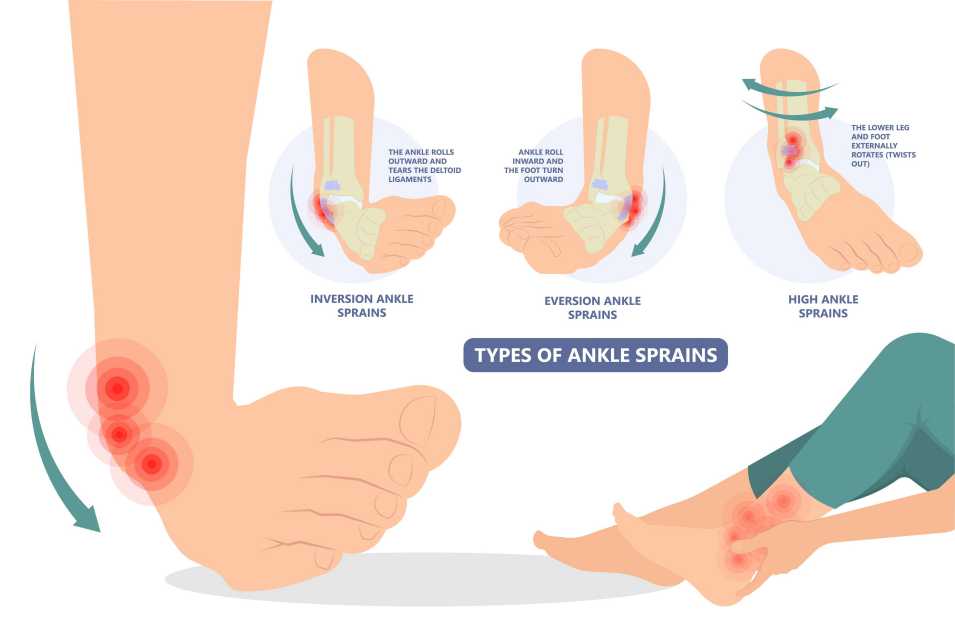 Compression Fracture Physical Therapy