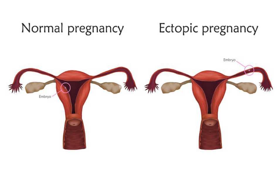 Everything You Wonder About Ectopic Pregnancy