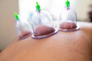Benefits of Hijama Therapy