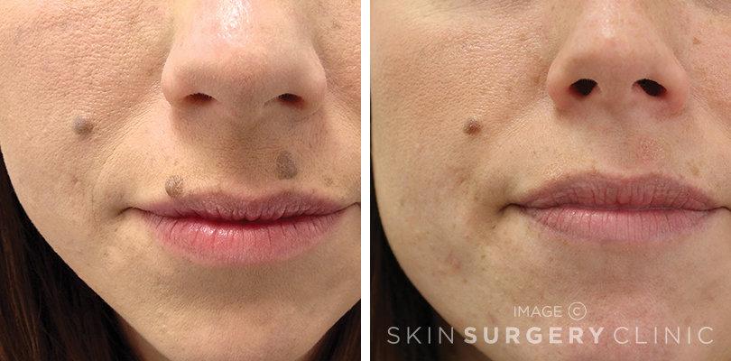 what-does-laser-skin-surgery-do-2 What Does Laser Skin Surgery Do?