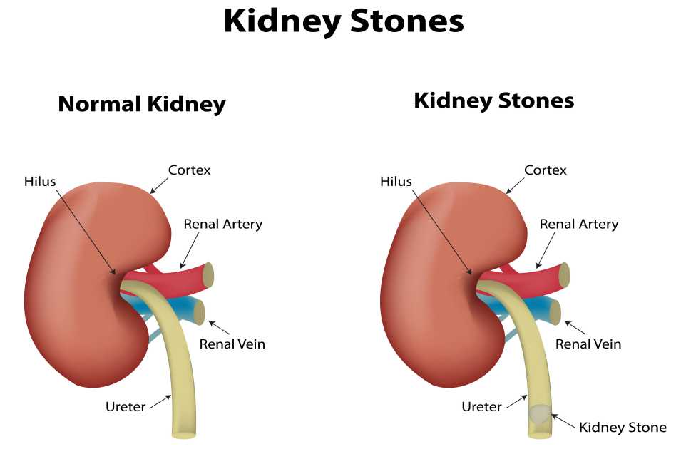 Can Stress Cause Kidney Stones? - Therapy NYC