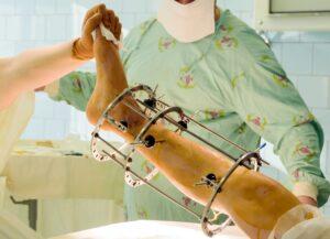 Height Lengthening Surgery Costs and Financing Options