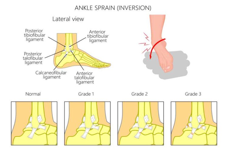 Subtalar Fusion Surgery - The Ultimate Guide To Understanding This ...