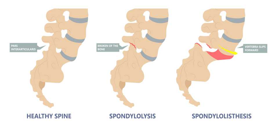 Anterolisthesis Vs. Spondylolisthesis - What's The Difference ...