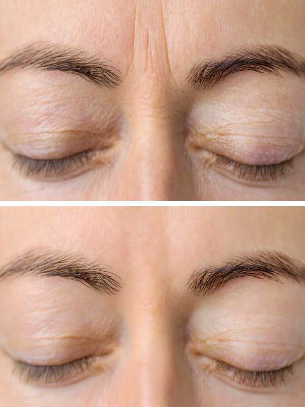 Transforming Lives with Botox for Migraines: Incredible Before and After Pictures that Speak Volumes