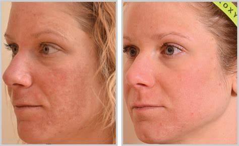 Halo laser treatment before and after