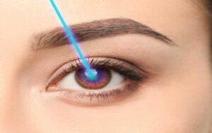 LASIK Eye Surgery