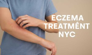 Eczema Treatment NYC – Finding Relief in the City That Never Sleeps
