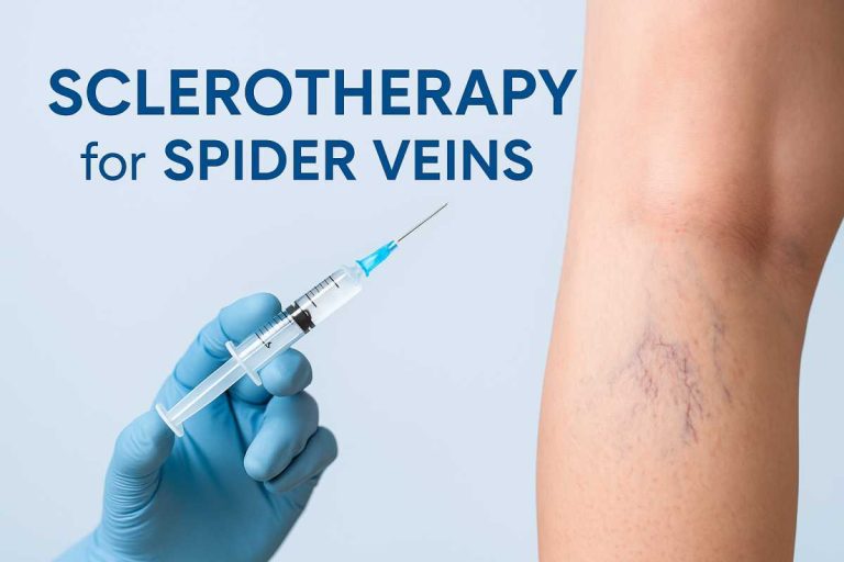 Sclerotherapy for Spider Veins: Cosmetic Relief with Proven Results