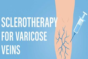 Sclerotherapy for Varicose Veins – Benefits, Risks, and Recovery