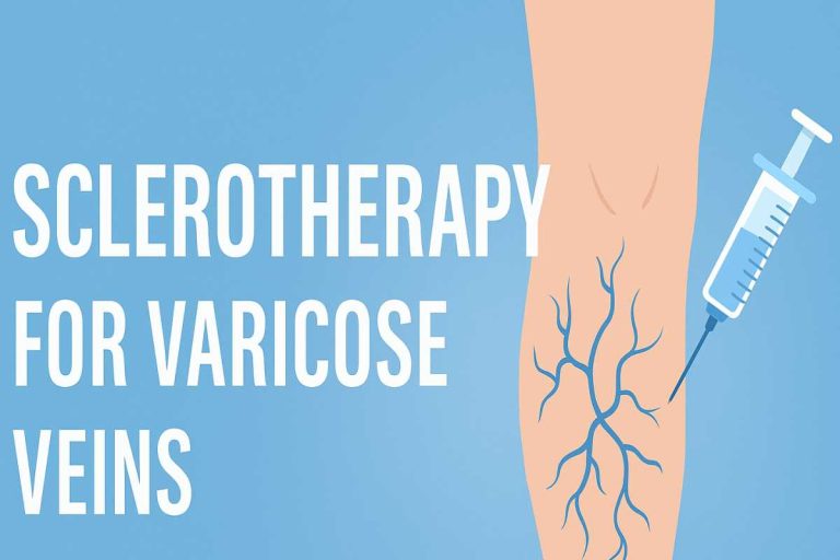 Sclerotherapy for Varicose Veins: Benefits, Risks, and Recovery in 2025